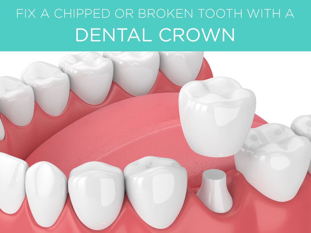 Monkstown dental crowns