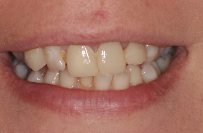 Monkstown dental implants before and after belfast