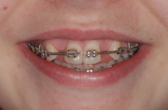 Monkstown Orthodontica before and after belfast