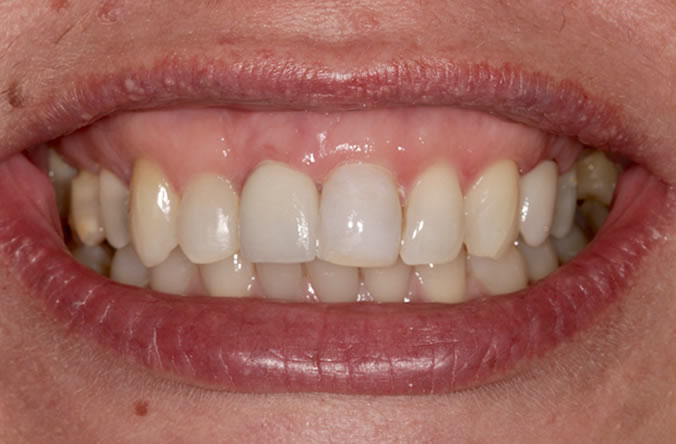 whiten your teeth in belfast