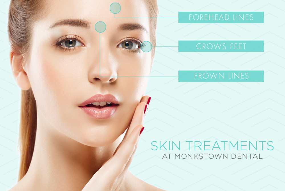 Skin locations at Monkstown