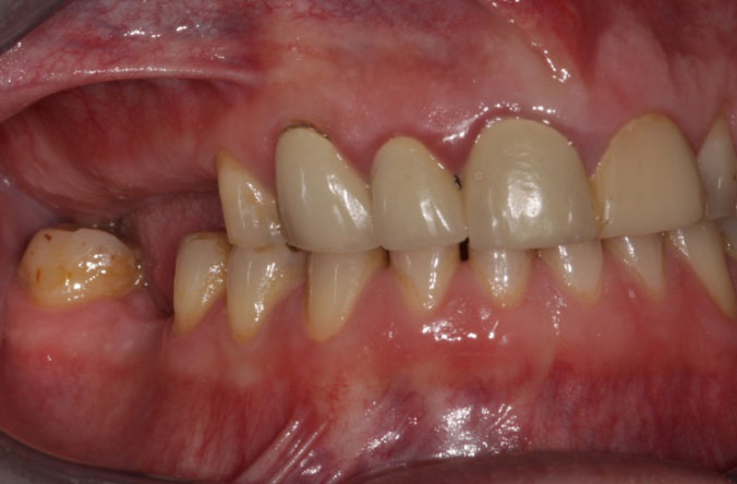 Monkstown dental tooth wear  belfast