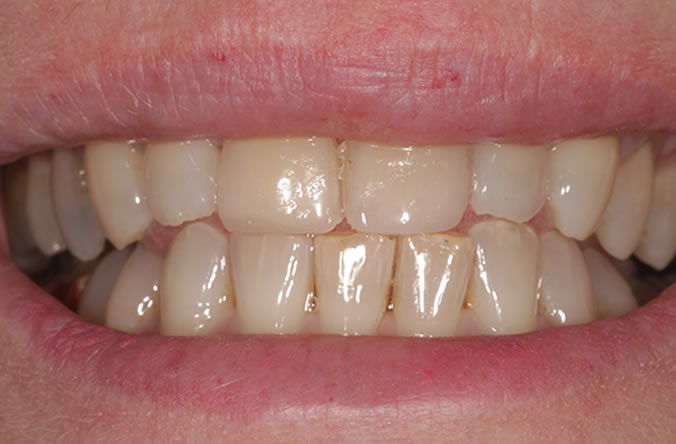 whiten your teeth in belfast