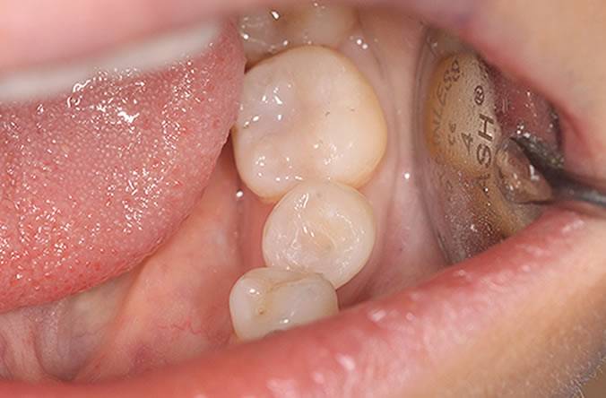 whiten your teeth in belfast