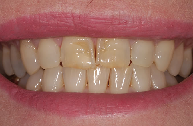 Monkstown white fillings before and after belfast