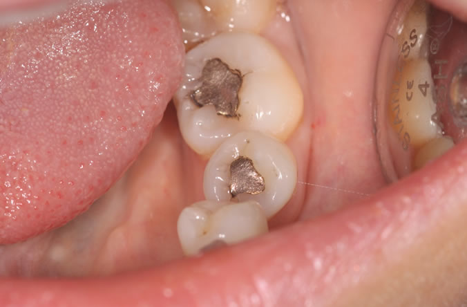 Monkstown white fillings before and after belfast